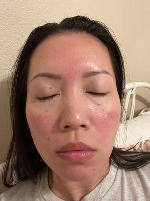 6 hours post chemical peel