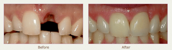 Porcelain Crown (Cap) Before and After
 Newport beach dentist