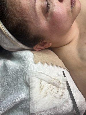 Dermaplaning facial- used to gently exfoliate dead skin with a refinded  facial blade.