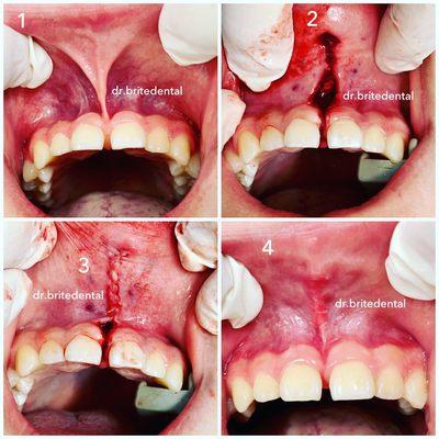 Frenectomy to eliminate cause of gap before braces treatment is done.