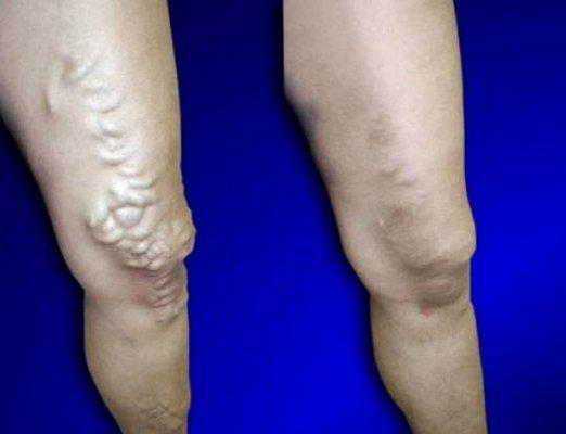 Before and After Vein Treatment