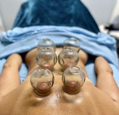 Cupping by our Massage Therapist