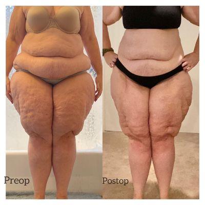 Before and after 2 Lipedema removal surgeries