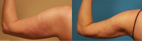 Arm Liposuction done by Dr Atluri