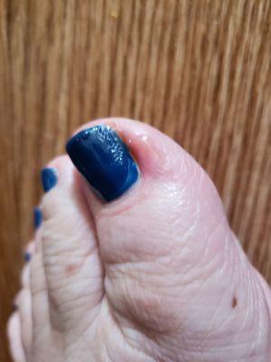 Day after pedicure.  Told her not to go down in there. Im diabetic and it gets easily infected. So upset