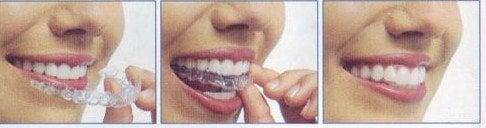 We offer invisalign at the most reasonable price