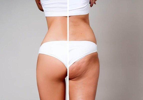 Before and After Cryo Slimming Procedure 
*Results vary