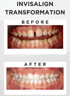 Invisalign Transformation