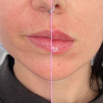 Lip filler before and after