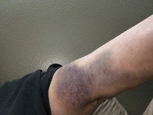 This is how my arm looked, this is when it was better