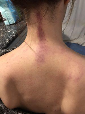 My neck after a massage today.