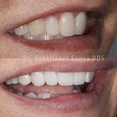 Smile enhanced by Dr. Samra with use of naturally appearing porcelain veneers.