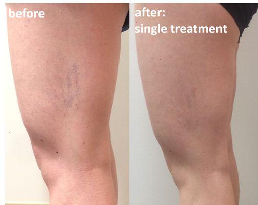 spider veins removal
spider vein treatment
sclerotherapy
laser vein treatment