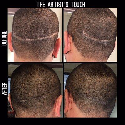 SCALP MICRO-PIGMENTATION             Scar from Hair Transplant filled with Micro-pigmentation at The Artist's Touch