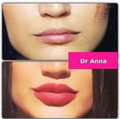 Lip augmentation for fuller lips.