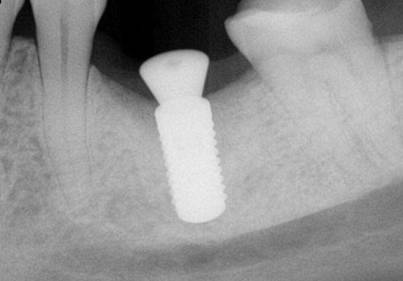 Single tooth implant replacing a molar tooth