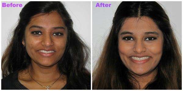 Before and after with Invisalign. Allows you to brush and floss your teeth normally for better periodontal health.