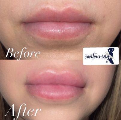 Lip filler and lip flip