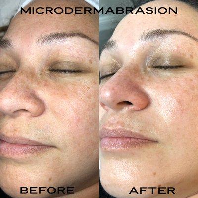 Microdermabrasion application before and after.