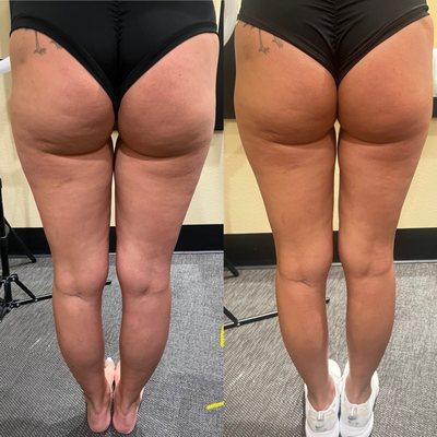 Cellulite and Body sculpting before/after