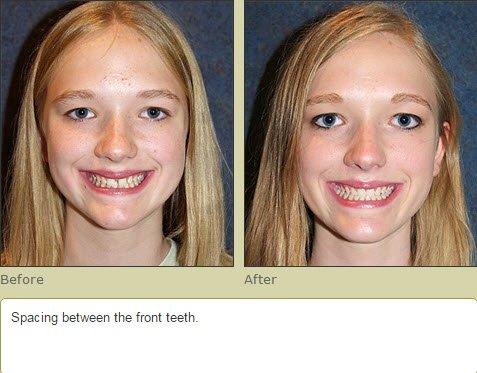 Invisalign Results