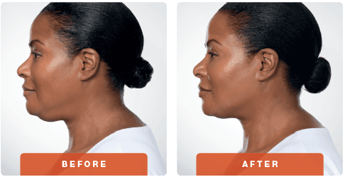 Kybella Before and After