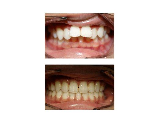 Before and after braces treatment.