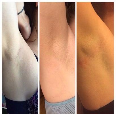 Post Underarm sugar hair-removal. Regrowth after 1, 2, 3 weeks