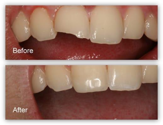 Crack and Chipped Tooth Restoration