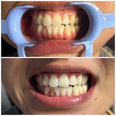 Ohana Teeth Whitening By DaVinci