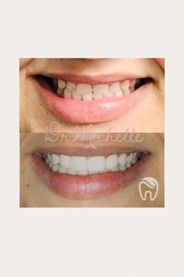 Porcelain veneers.(6)