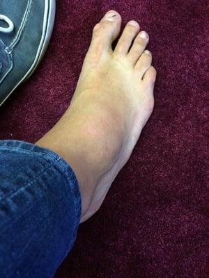 Broken foot