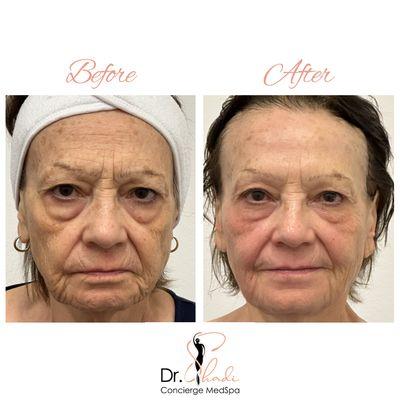 Exion Face Applicator + Sculptra results.