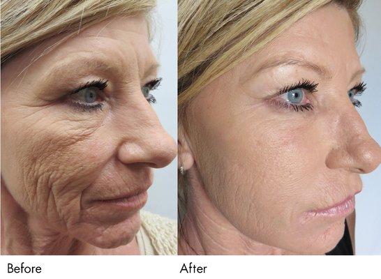 Micro-needling -Before & After.