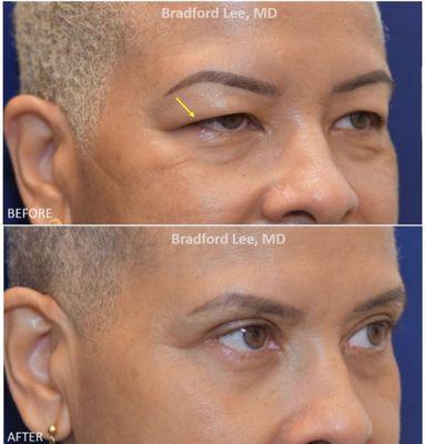 Upper blepharoplasty