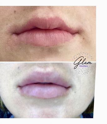 Juvederm filler