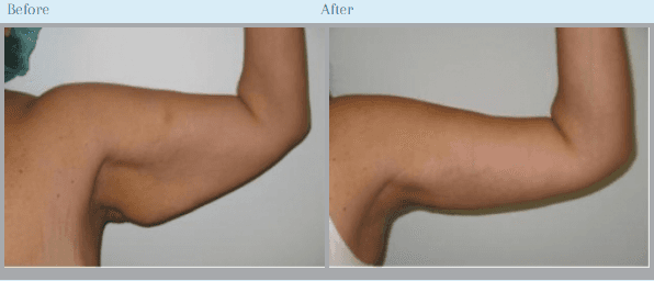 Arm Lift: Before & After