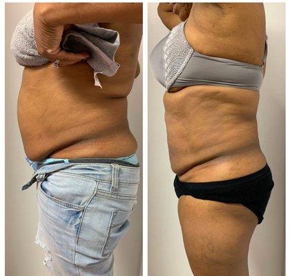 Progress photos of laser Lipo + Lipo Cavitation