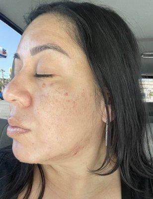 Only two treatments: Microneedling and Chemical Peel. My client looked like a new person just 10 days after receiving her chemical peel.