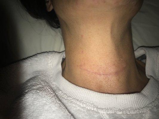 Neck incision-6 weeks post-op