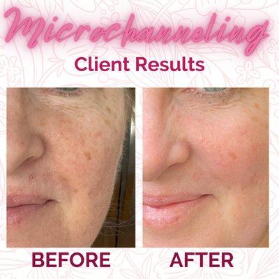 Microchanneling Client Results