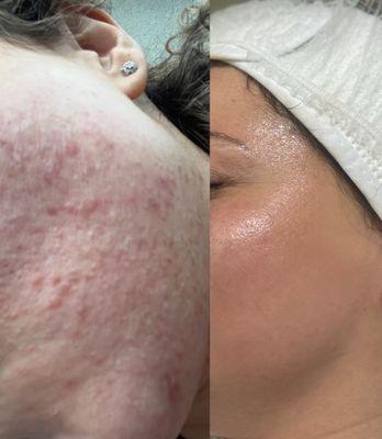 Before & After second treatment!