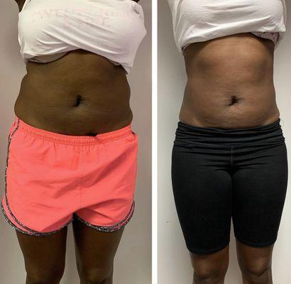 Progress photos of laser Lipo + Lipo Cavitation