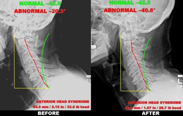 Before and After Structural Correction of a Geriatric Patient with Resolution of Chronic Constipation and Low Back Pain