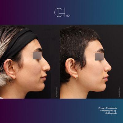 Carlo Honrado, M.D., F.A.C.S.- Primary Rhinoplasty patient 6 months post-op