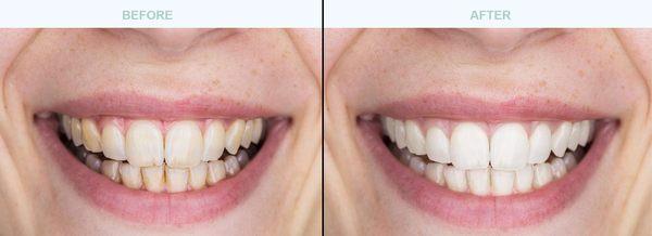 Dental Cleaning (Not Whitening!!) can make a big difference