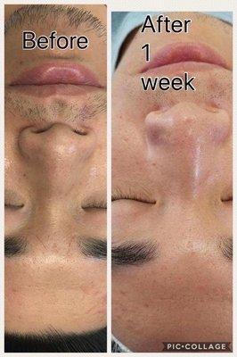 jet peel facial