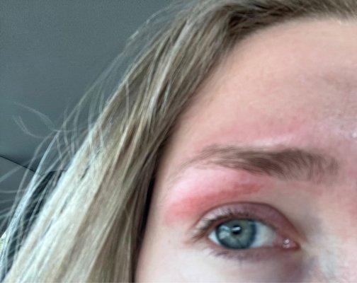 The burn they did after waxing my eyebrows