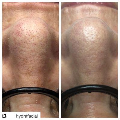 Hydrafacial removes blackheads and replenishes your natural hydration