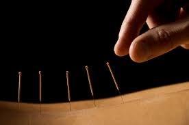 Dry Needling is a form of acupuncture known as "Ashi" acupuncture. It is highly effective when practiced by a qualified acupuncturist doctor